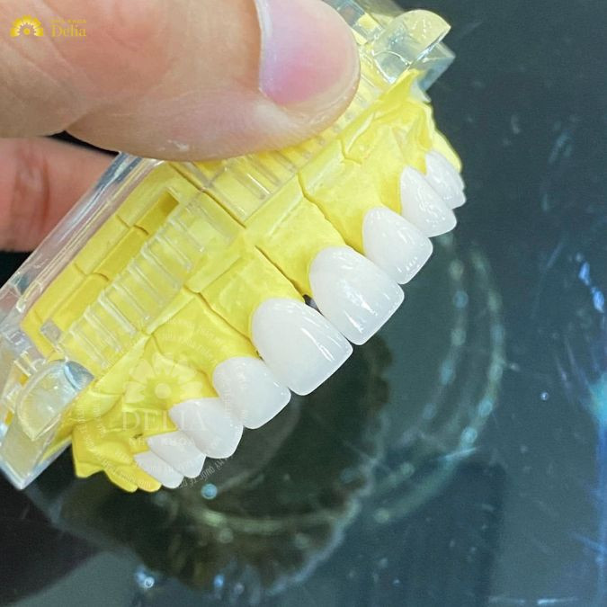 Quy trình chế tác sườn răng sứ nhất định bạn cần biết