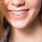 Khi nhận thấy dấu hiệu niềng răng xong bị hô, điều quan trọng là bệnh nhân cần tìm đến nha khoa để được thăm khám và tư vấn kịp thời