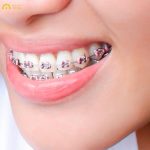 mắc cài kim loại đảm bảo hiệu quả điều trị cao
