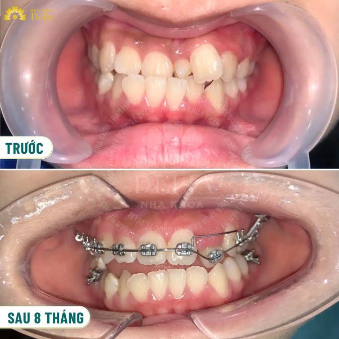 Niềng răng có tác dụng gì? Có nên niềng răng không?