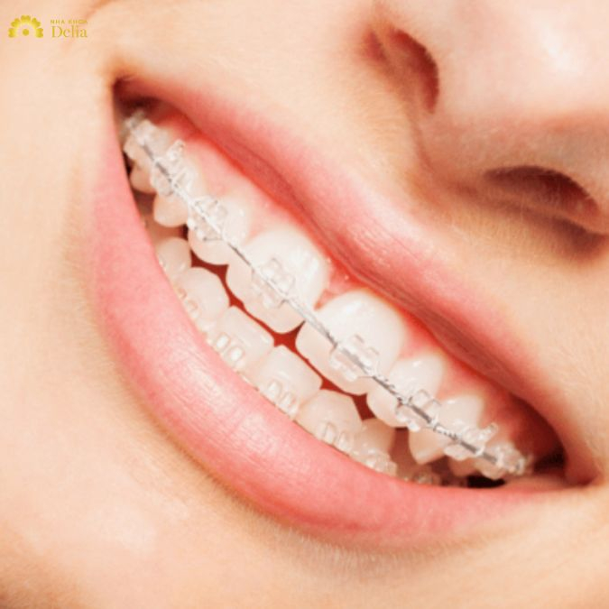 Trả lời: Niềng răng hô nhẹ có phải nhổ răng không? Nên lưu ý gì?