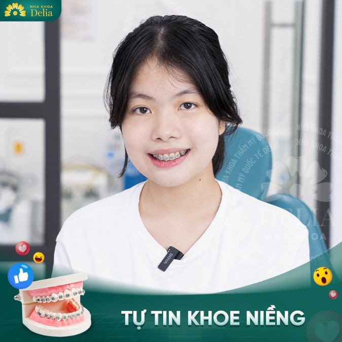 Trả lời thắc mắc: Răng hô nhẹ niềng mất bao lâu?