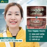 Nha Khoa Delia tự hào là địa chỉ niềng răng uy tín được hàng ngàn khách hàng tin tưởng lựa chọn