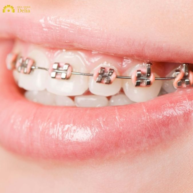 Giải đáp: Móm có niềng răng được không? Niềng loại nào?