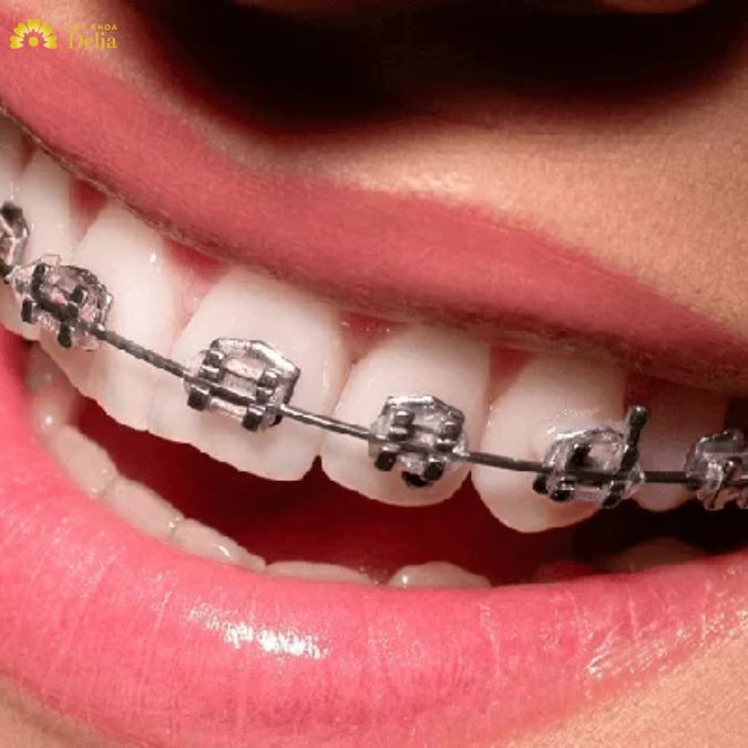 Niềng răng hô nhẹ bao nhiêu tiền? Đắt hay rẻ?