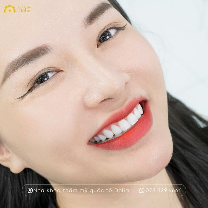 Răng sứ Diamond Bio – Độ chính xác và bền màu tuyệt đối