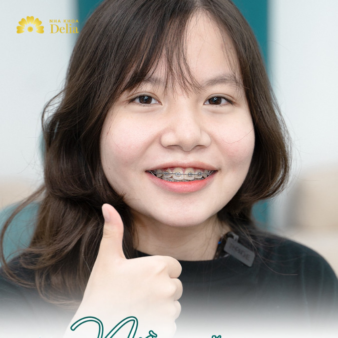 Chia sẻ kinh nghiệm niềng răng thưa cực quan trọng