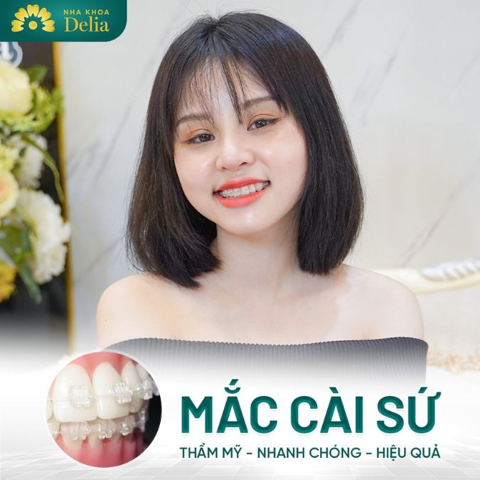 Trả lời câu hỏi: Mới niềng răng đau mấy ngày?