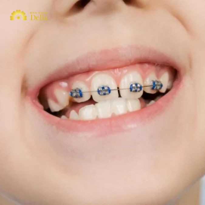 Niềng 1 cái răng có được không? Bác sĩ giải đáp