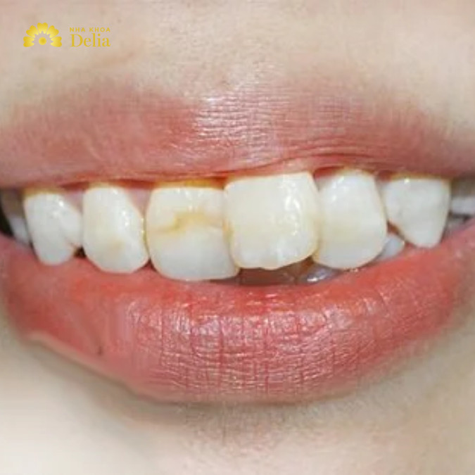 Niềng 2 răng cửa bị lệch giá bao nhiêu tiền, đắt hay rẻ?