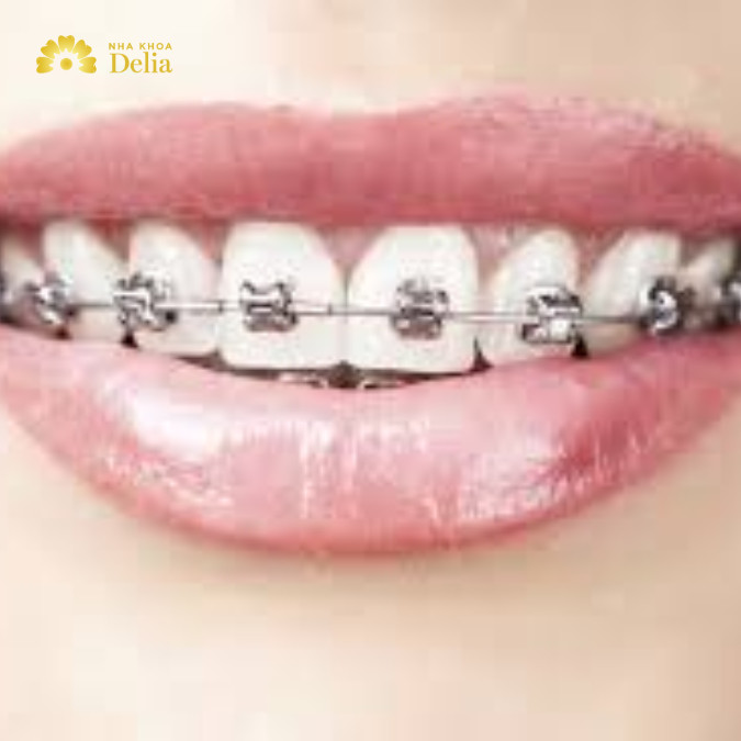 Niềng 6 răng cửa bằng phương pháp nào hiệu quả nhất?