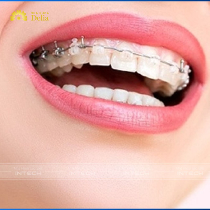Niềng răng bao nhiêu tiền 1 hàm, bảng giá cập nhật 2024
