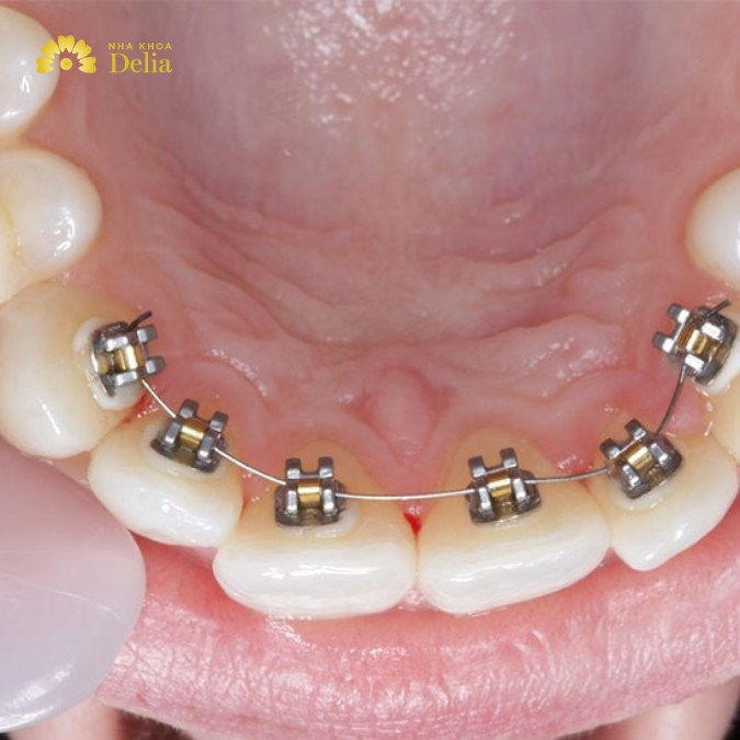 Hỏi đáp: Niềng răng bên trong có hiệu quả không?