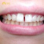 Niềng răng cửa bị lệch là như thế nào, hiệu quả không?