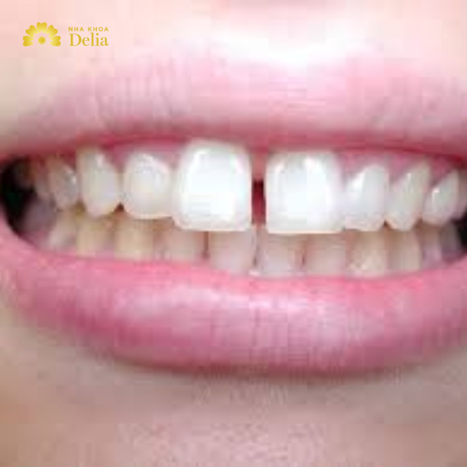 Niềng răng cửa thưa mất bao nhiêu tiền? Bảng giá cập nhật 2024