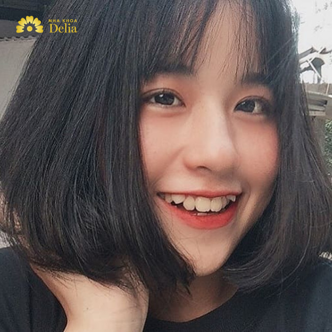 Giải Đáp: Niềng răng giữ lại răng khểnh có được không?