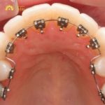 Niềng răng hàm dưới giá bao nhiêu, đắt hay rẻ?