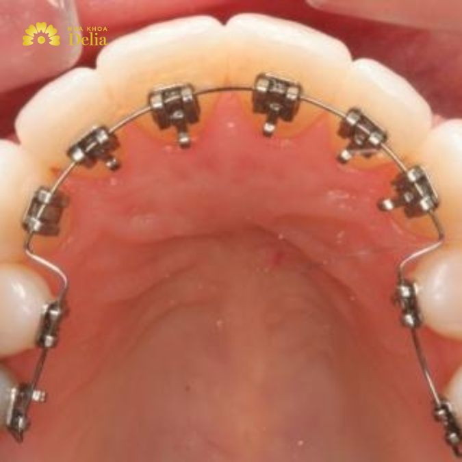 Niềng răng hàm dưới giá bao nhiêu, đắt hay rẻ?