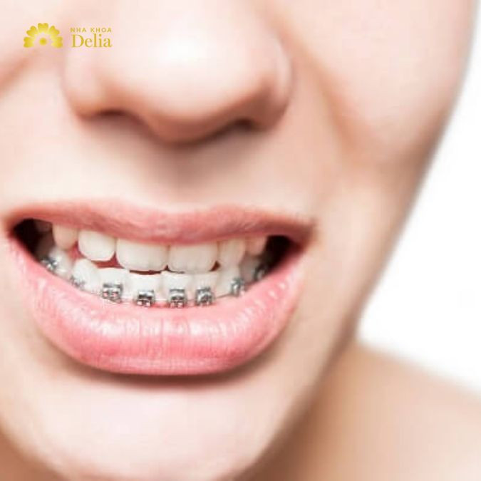 Giải đáp: Niềng răng hàm dưới mất bao lâu thì có kết quả?
