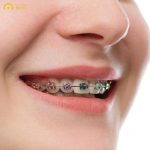Đối với trường hợp móm nhẹ, bác sĩ có thể chỉ định đeo hàm duy trì và tái khám thường xuyên để theo dõi tình hình