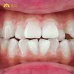 Niềng răng khấp khểnh bằng phương pháp nào tốt?
