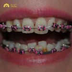Niềng răng khấp khểnh bao nhiêu tiền? Bảng giá cập nhật 2024