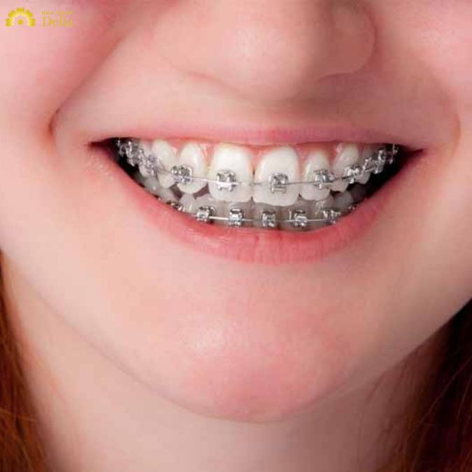 Niềng răng bao nhiêu tiền 2 hàm? Bảng giá niềng răng 2 hàm chi tiết