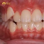 Niềng răng khểnh là như thế nào, có nên thực hiện không?