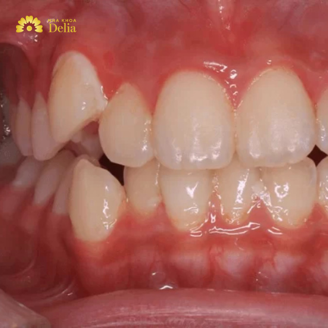 Niềng răng khểnh là như thế nào, có nên thực hiện không?