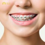 Giải đáp: Niềng răng khểnh bao nhiêu tiền, đắt hay rẻ?