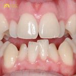 Niềng răng không đều có hiệu quả không, giá bao nhiêu tiền?