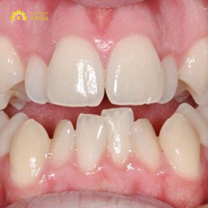 Niềng răng không đều có hiệu quả không, giá bao nhiêu tiền?