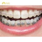 Niềng răng khớp cắn ngược phương pháp nào hiệu quả cao?