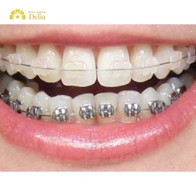 Niềng răng khớp cắn ngược phương pháp nào hiệu quả cao?