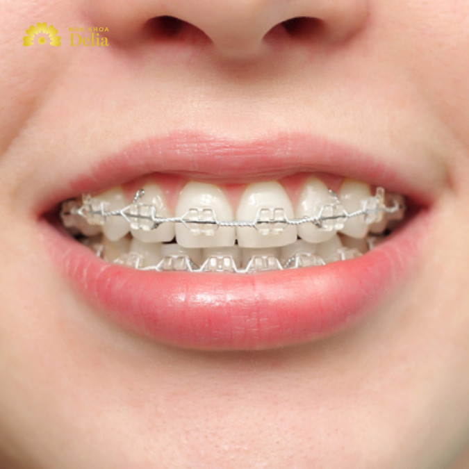 Trả lời: Niềng răng lệch khớp cắn bao lâu thời gian? 