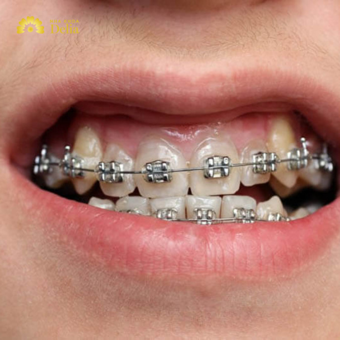 Cập nhật mới nhất: Niềng răng lệch khớp cắn bao nhiêu tiền?