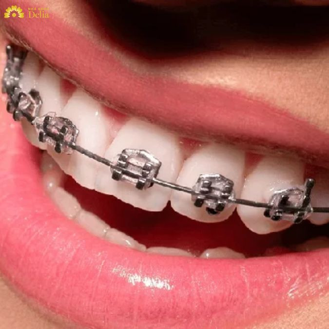 Giải đáp thắc mắc: Niềng răng móm có phải nhổ răng không?