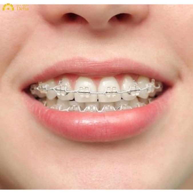 Niềng răng móm có đau không? Đau nhất giai đoạn nào?