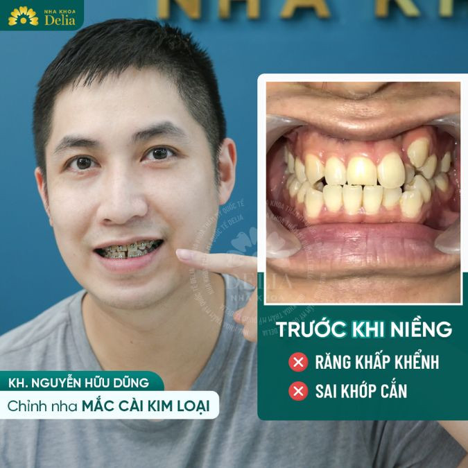 Sâu răng có niềng răng được không? Lưu ý quan trọng