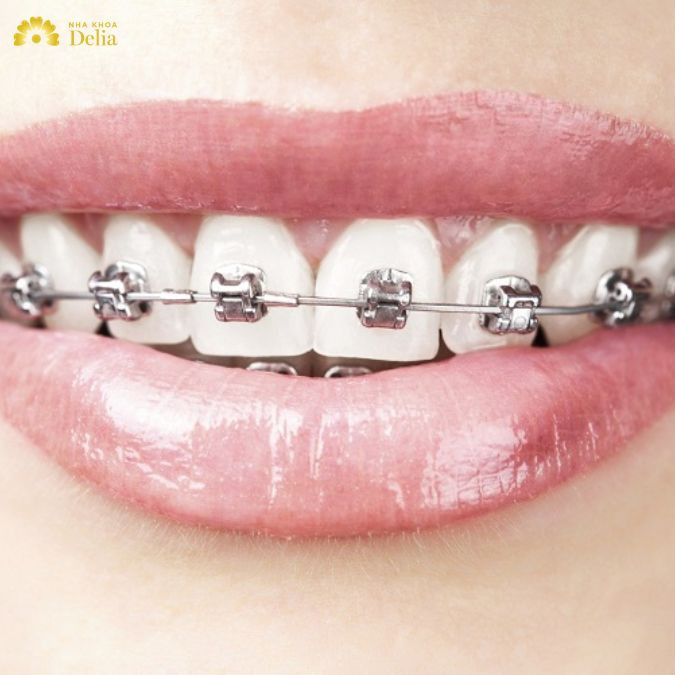 Khám phá quá trình niềng răng móm cải thiện thẩm mỹ