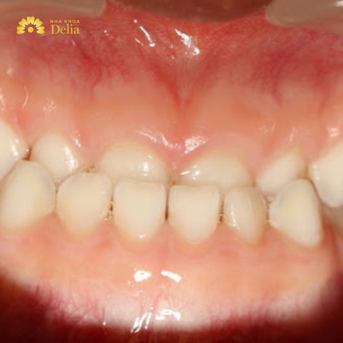 Giải đáp: Niềng răng quặp khó hay dễ, bao lâu có hiệu quả?