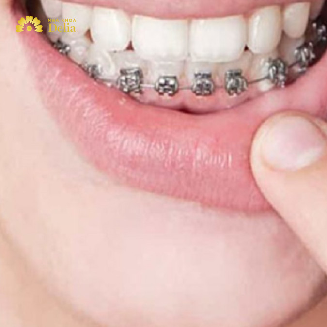 Niềng răng thưa hàm dưới phương pháp nào hiệu quả nhanh?