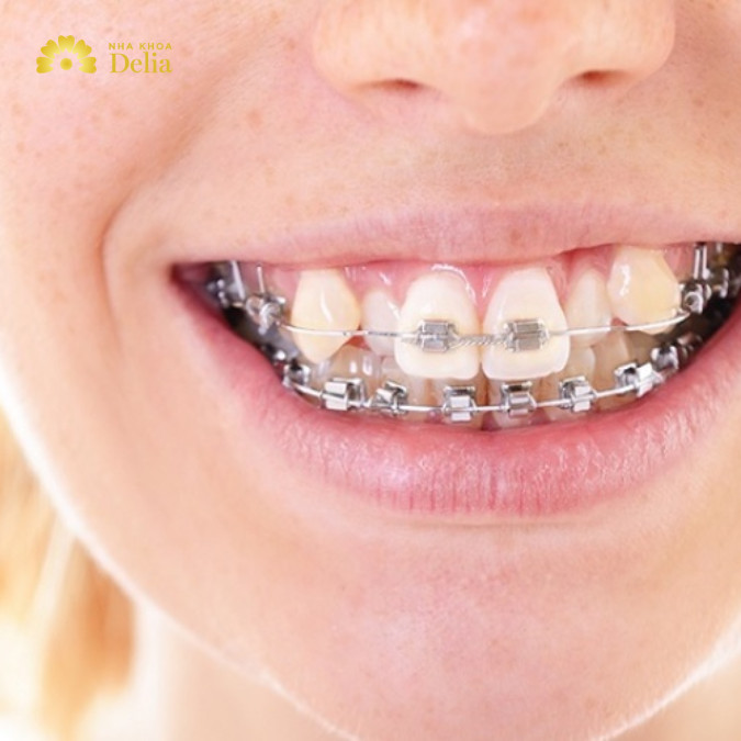 Quy trình niềng răng khấp khểnh chi tiết từng giai đoạn