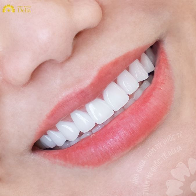 Răng sứ Diamond Vita – Giải pháp làm đẹp răng toàn diện