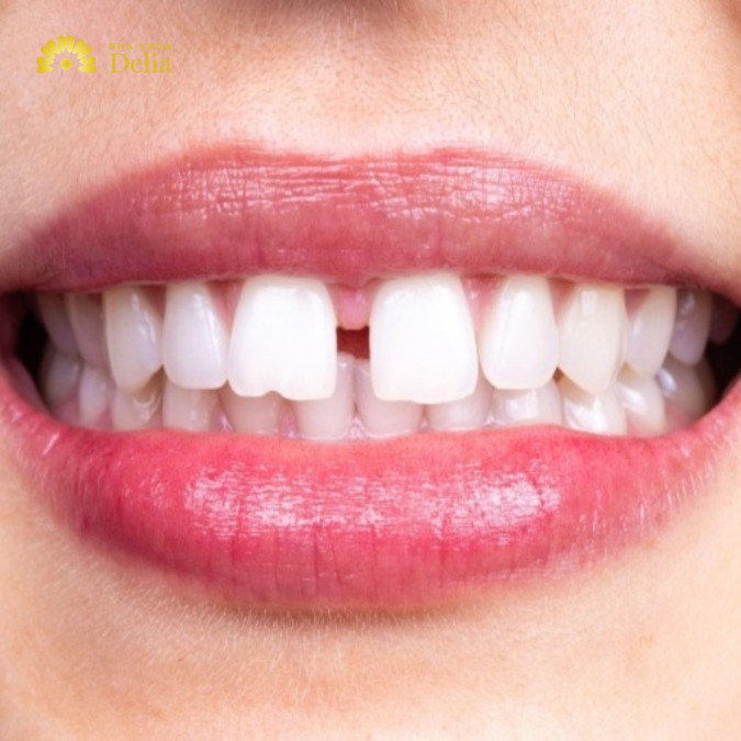 Răng thưa niềng răng có hiệu quả không? Nên niềng như thế nào?
