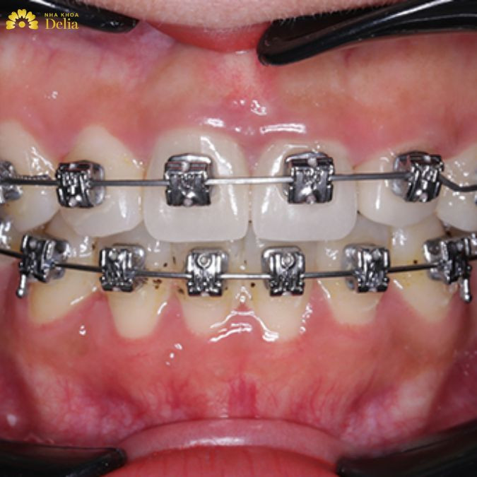 Giải đáp: Xương hàm mỏng có niềng răng được không?