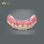 Hàm tháo lắp trên Implant là như thế nào, có nên dùng không?