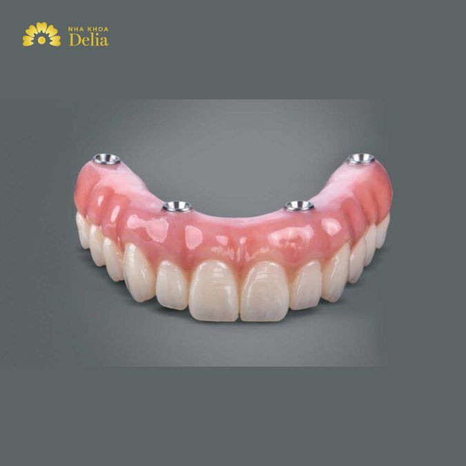 Hàm tháo lắp trên Implant là như thế nào, có nên dùng không?