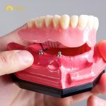 Hàm tháo lắp trên Implant, bao gồm các công nghệ như All-on-4 hoặc All-on-6