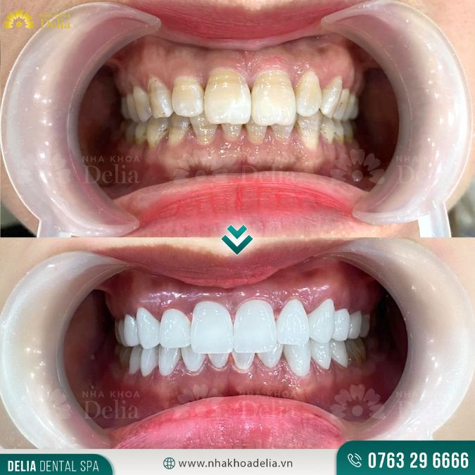 Khách hàng bọc răng sứ Ceramill đánh giá gì? – Nha khoa Delia
